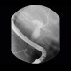 Dilatation of biliary duct, sclerosis of papilla: RF - Fluoroscopy